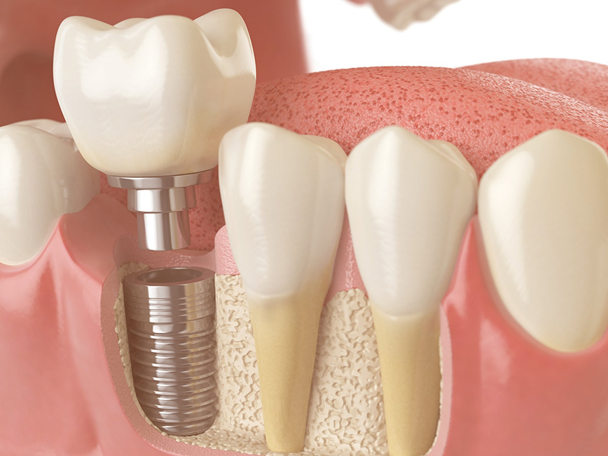tipos-de-implantes-dentarios-1